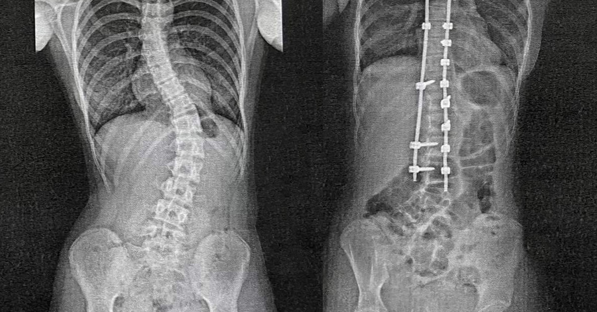 Scoliosis Treatment