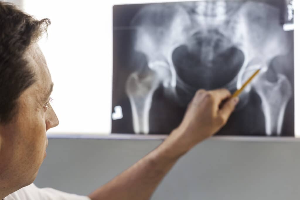 Hip Labral Tear Symptoms: Causes, Treatment, and Physical Therapy